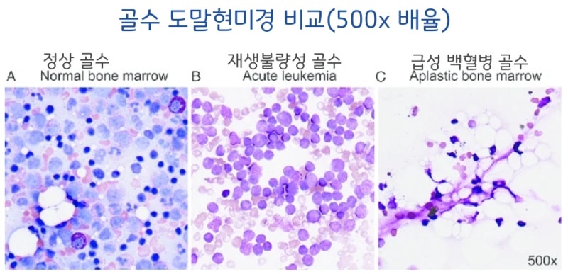 골수가 마르는 만성 질환 ‘재생불량성 빈혈’, 한약 치료 효과
