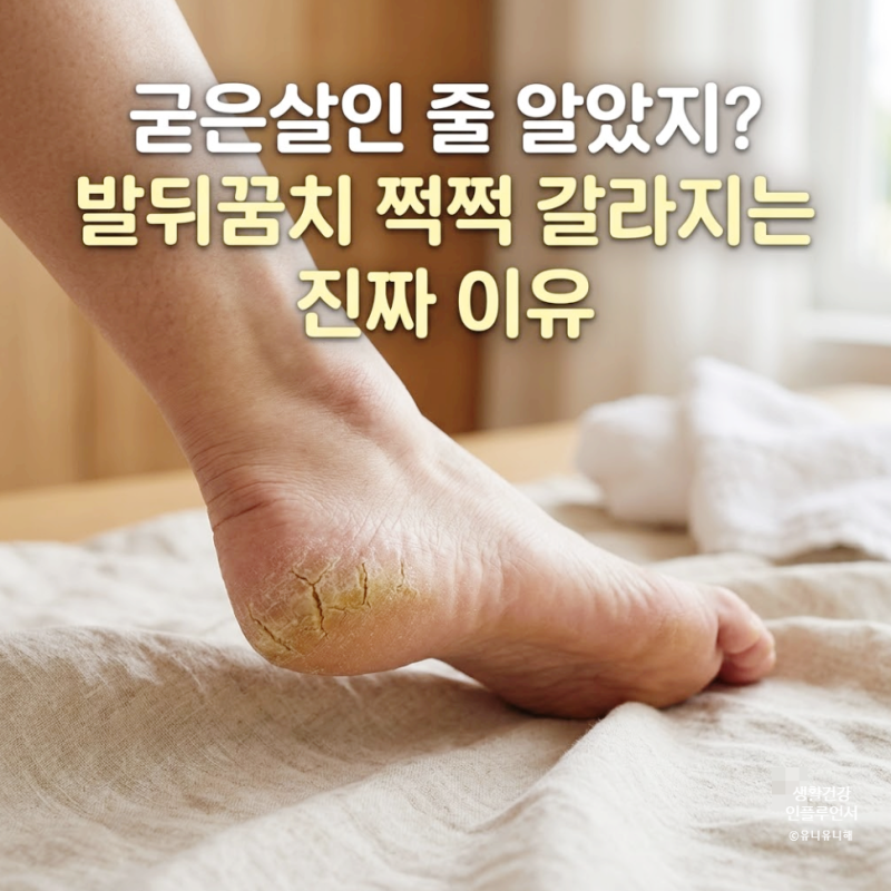 발뒤꿈치 갈라짐 각질인 줄 알았는데 이것? 무좀각질 구볍법과 관리 루틴