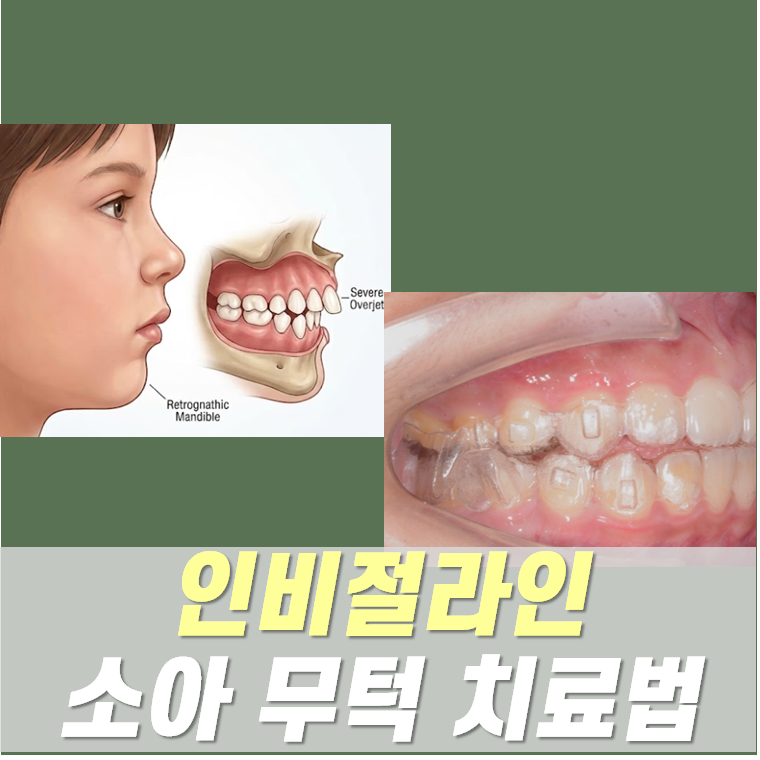 인비절라인으로 소아 무턱 교정하는 방법, 봉선동 교정치과