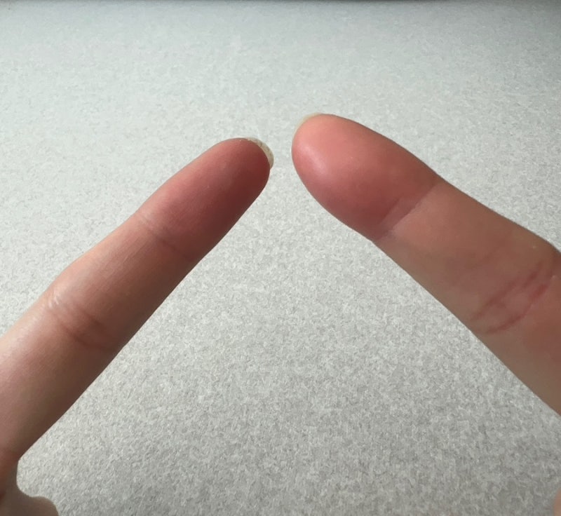 조갑주위염 증상 - 손톱 거스러미 뜯다 퉁퉁 부은 후기, 병원 위치 및 연고 초기대응 팁