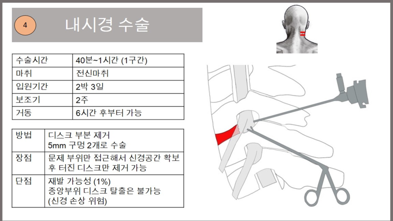 단방향 내시경 수술을 이용한 목디스크치료