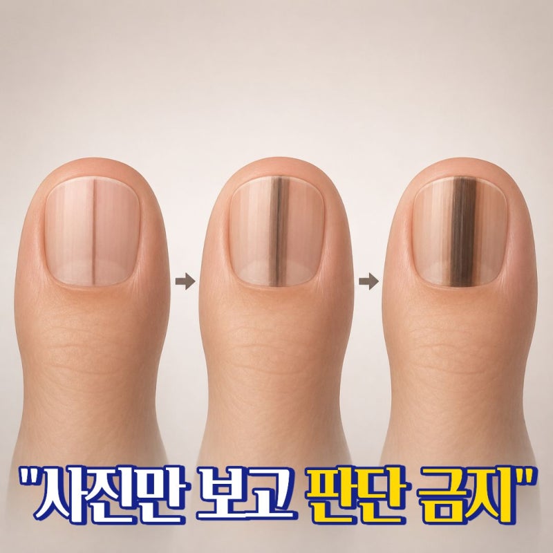 발톱흑색종 증상 발톱에 생긴 검은 줄 점점 진해진다면