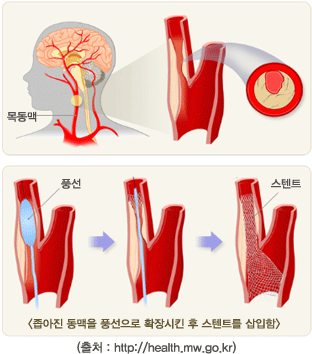 풍을 맞는다? 골든 타임이 중요합니다! '뇌졸중' - (1) 허혈성 뇌졸중[뇌경색]