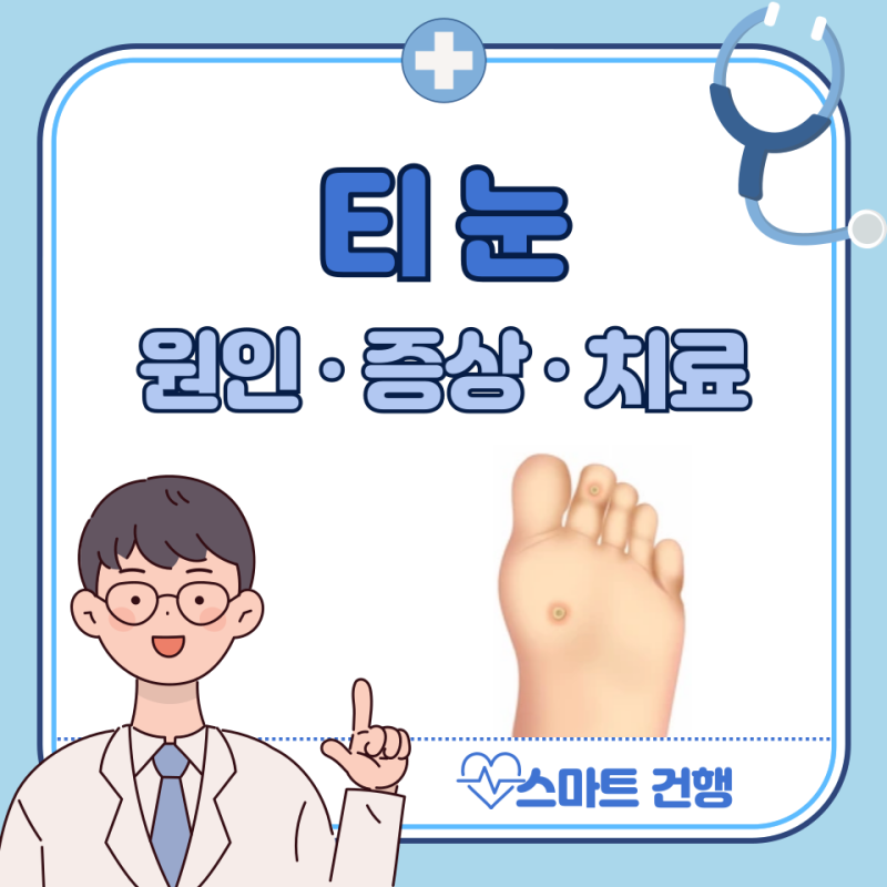 발바닥 티눈 제거 방법, 티눈 생기는 이유 : 밴드, 연고, 약