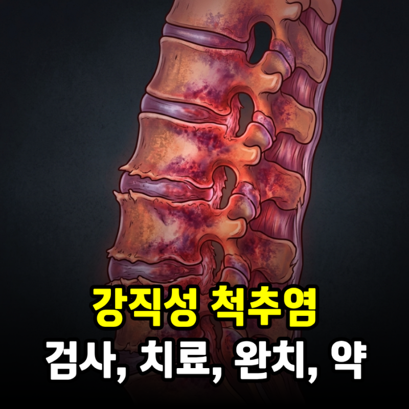 강직성 척추염 검사와 치료, 완치