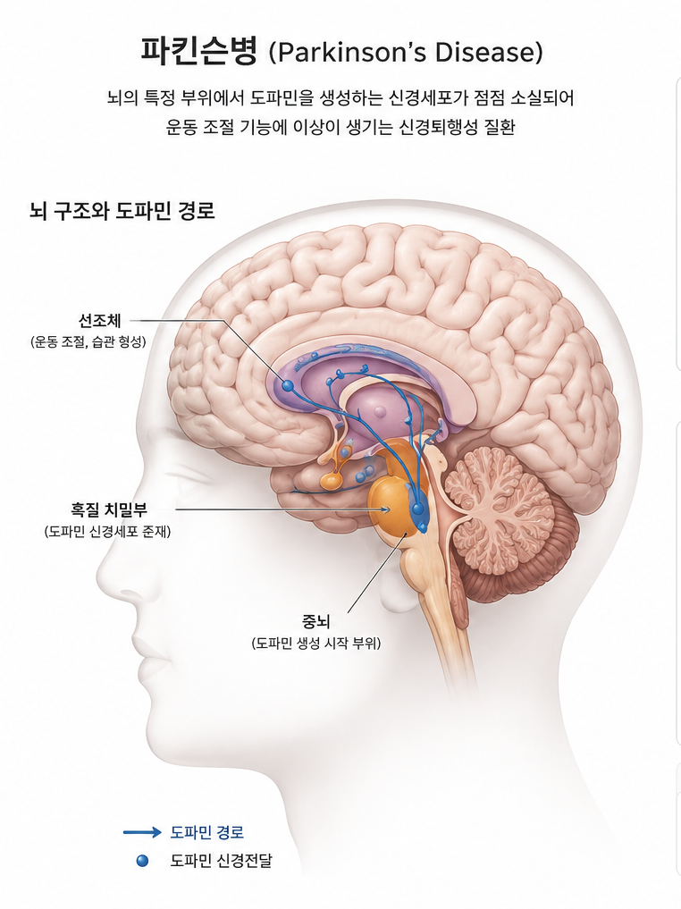 파킨슨병과 치매의 차이점