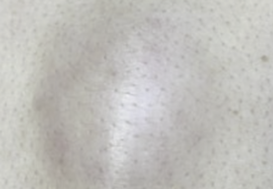 표피낭종 증상과 원인부터 제거 관리 방법까지 총정리