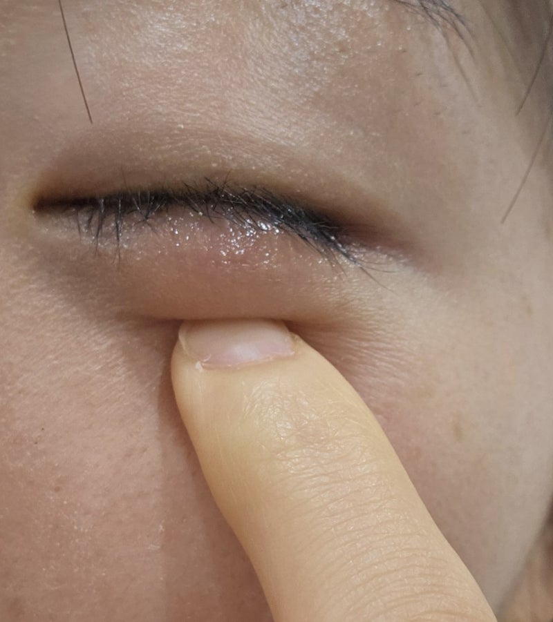 눈 밑 덩어리, 다래끼인 줄 알았는데 산립종? 산립종 절개술 후기 (수술 과정/가격/통증/흉터)