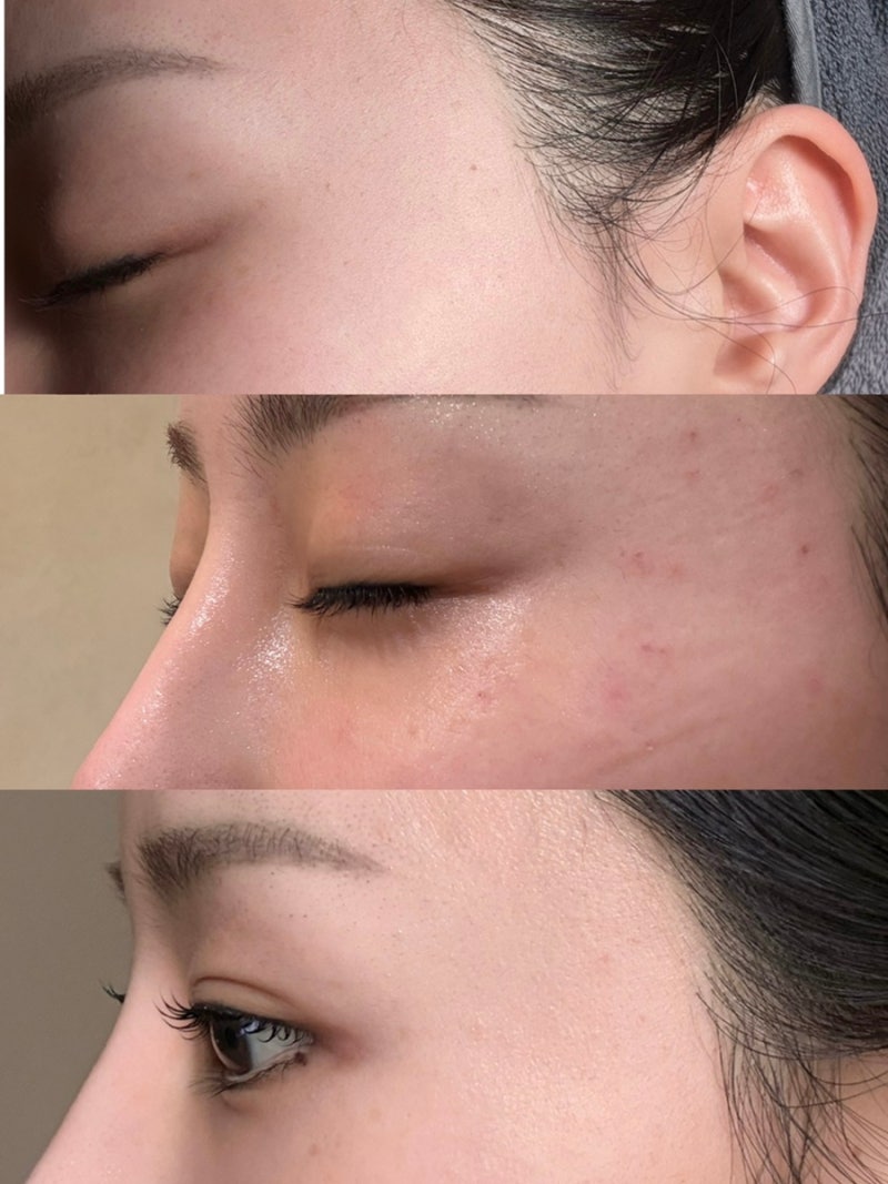 노원편평사마귀 거우침 후기, 여름에도 부담 없었던 제거치료 솔직 리뷰