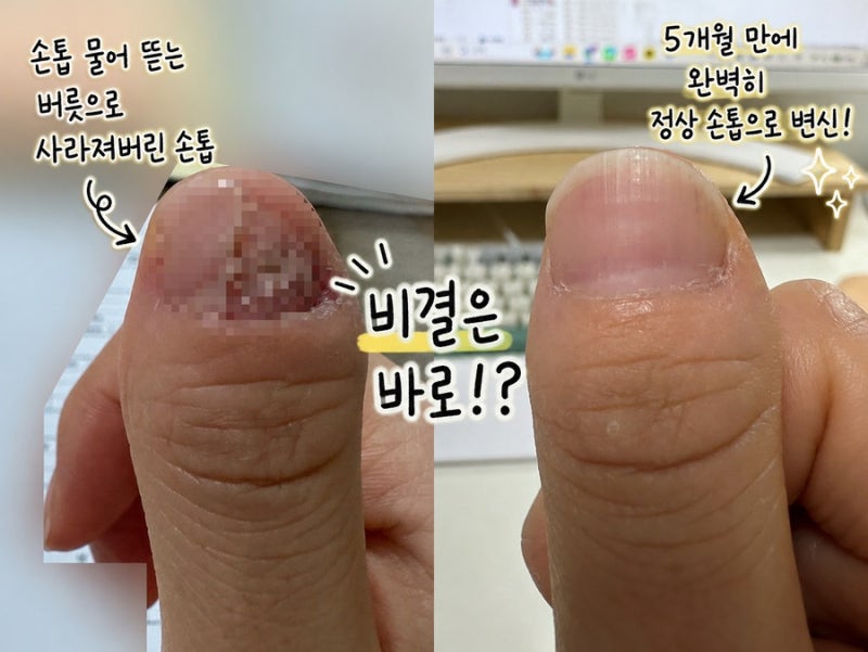 손톱 뜯는 버릇으로 절반 없어진 손톱 기르기 성공한 방법 공유