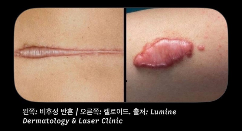제왕절개 흉터 9개월간의 변화 비후성반흔 켈로이드 주사 후기