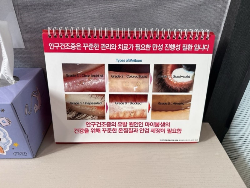 안구건조증 CCH 시술 후기, 리피플로우 끝나고 결막이완증 치료 받은 날