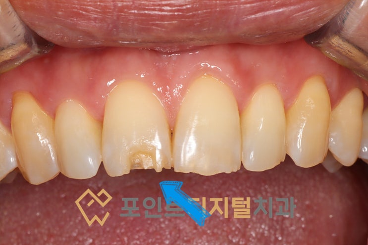 [앞니파절 치료] 떨어지지 않는 자연스러운 레진 수복, 당일 완성! / 천안 아산