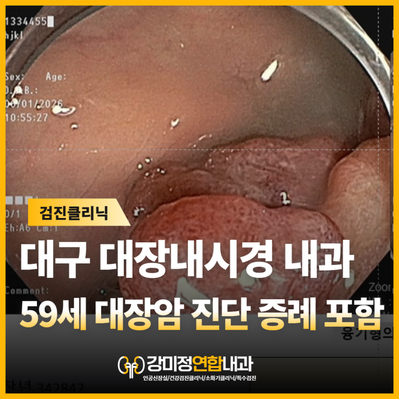 50세가 넘도록 한 번도 대장내시경을 받아보지 않으셨나요?<59세 여성, 첫 대장내시경에서 발....