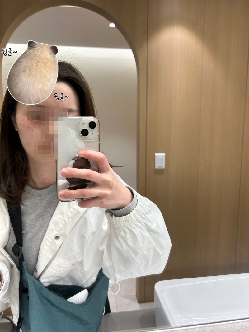 여름 얼굴 눈가 편평사마귀 제거 후기(고통, 제거 후 10일 간 변화, 관리법, 안연고, 기미, 세....