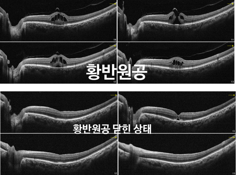 글자가 휘어지고 가운데가 안 보인다면? 황반원공(Macular Hole) 수술 실제 증례 (수술 과정부터....