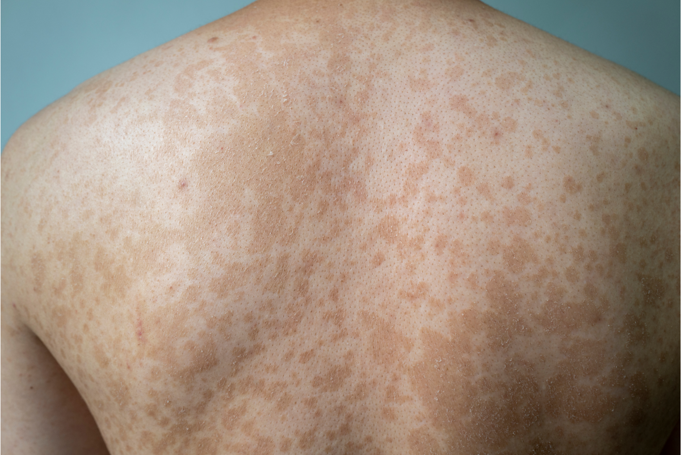 여름철 등·가슴에 얼룩덜룩한 반점, 어루러기일까요? (전풍/pityriasis versicolor)