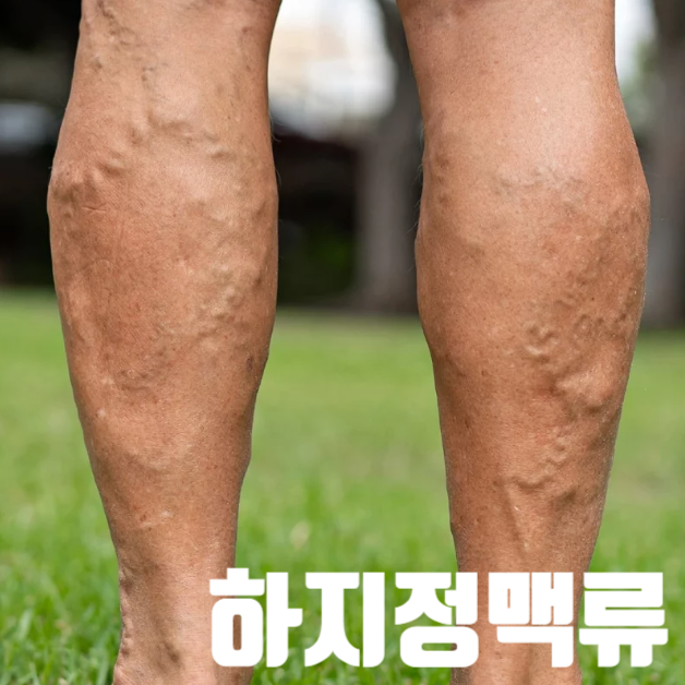 하지정맥류 원인 증상 치료 예방, 압박스타킹 착용법, 하지불안증 차이, 약 추천