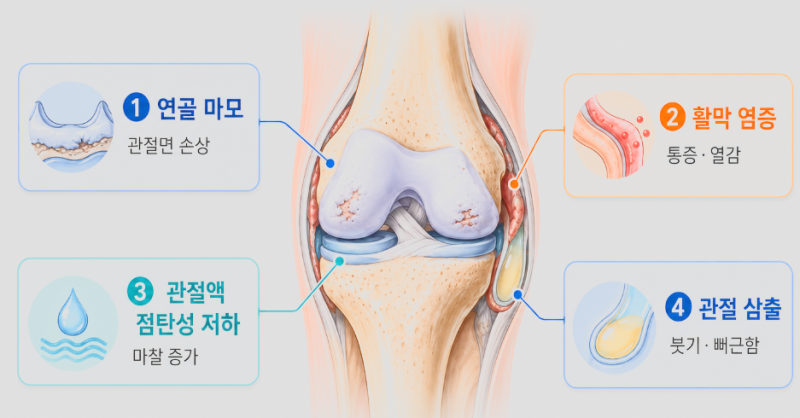 무릎 연골주사, 콘쥬란 주사, DNA주사, 콜라겐 주사