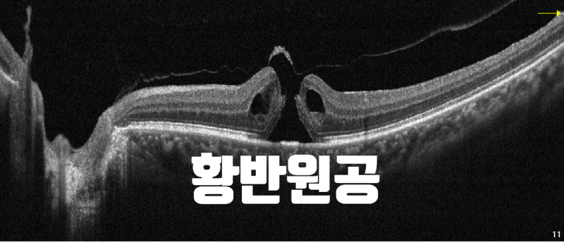 황반원공 수술, 어떤 방법이 가장 좋을까요?