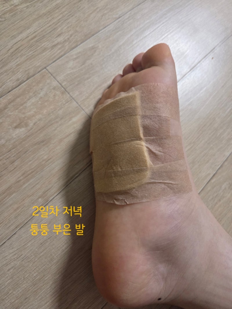 발바닥 사마귀 냉동치료 피물집 이렇게 심한거 본 사람? 두달 후기