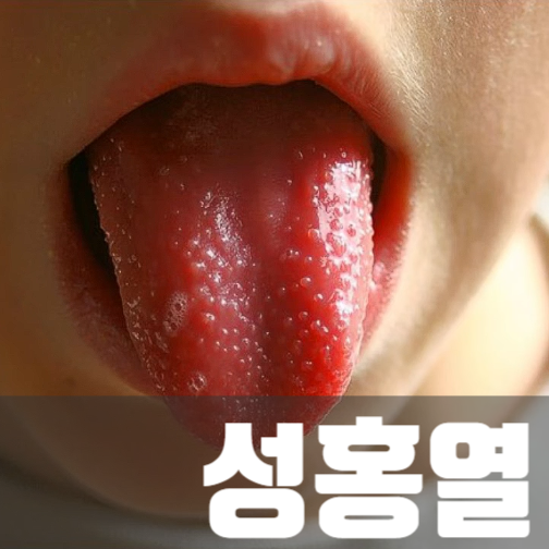 성홍열 뜻 증상, 고열 딸기혀, 감기로 오해, 방치하면 합병증