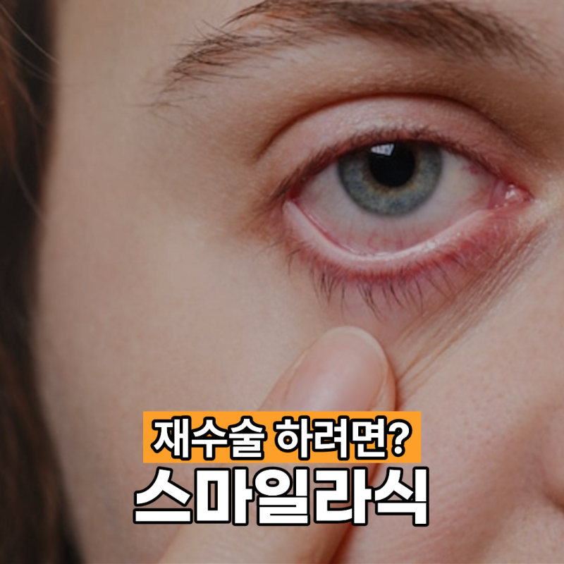 스마일라식 재수술, 얼마나 있다가 할 수 있을까요?