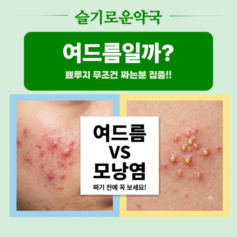 여드름인 줄 알았는데 모낭염? 짜면 안되는 여드름? 여드름VS모낭염 뭐가달라요?