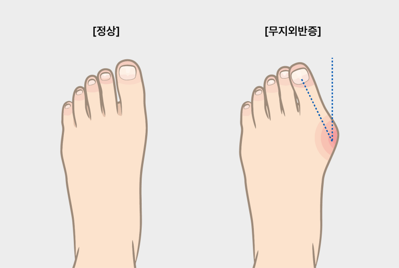 무지외반증 고치는 방법! 간호사가 알려주는 무지외반증(엄지발가락 통증) 원인부터 교정, ....