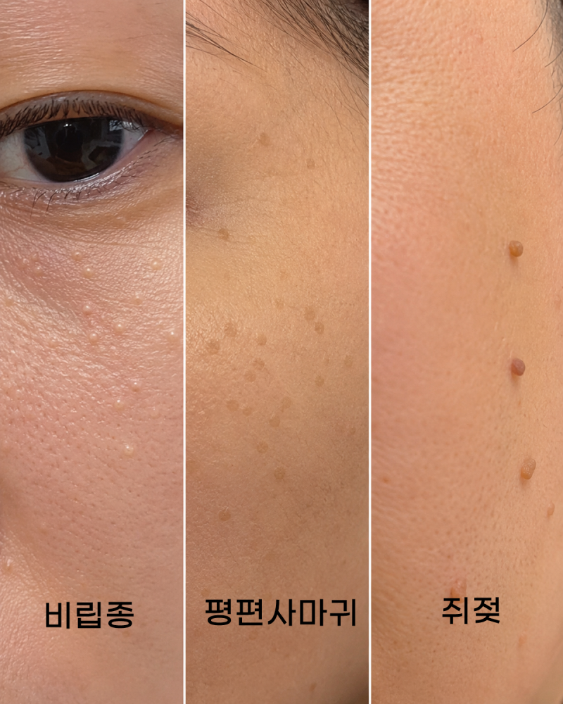 얼굴 비립종 평편사마귀 쥐젖 차이점 - 원인부터 제거법까지