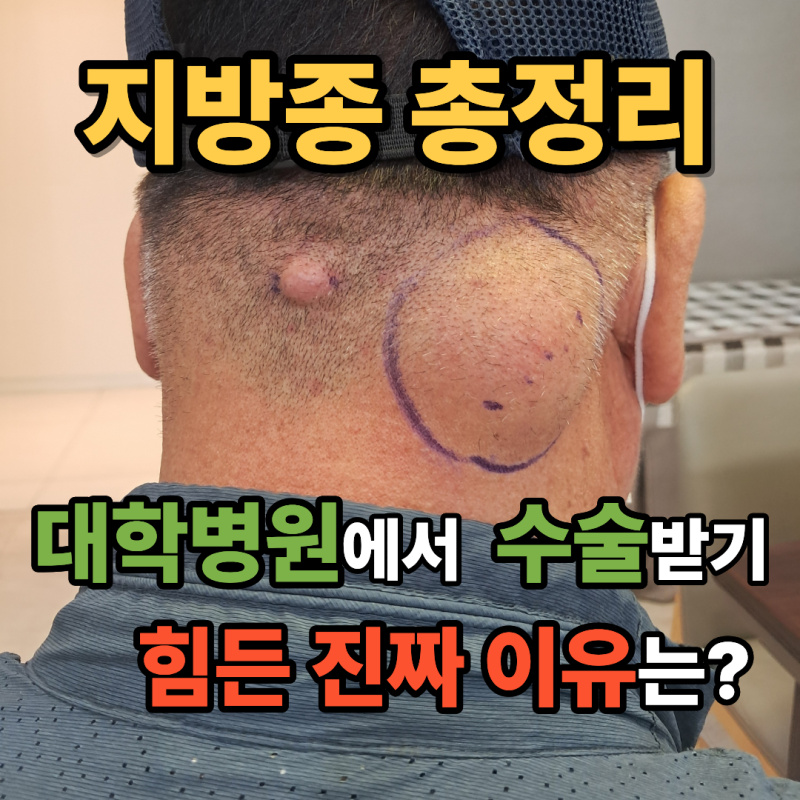 지방종 총정리 대학병원에서 지방종 수술받기 힘든 진짜 이유는?