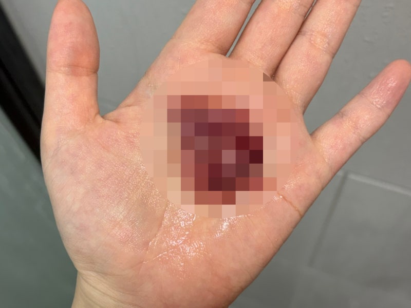 화학적유산 뜻 원인 증상 시기와 출혈 생리, 유산 3번 후 관리 후기
