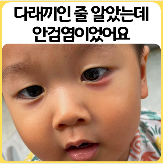 아기 다래끼인 줄 알았는데 안검염이었어요 (증상 차이·치료 후기)