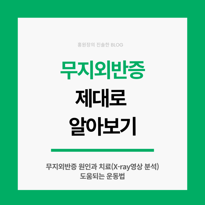 엄지발가락이 점점 휘어진다면? 무지외반증 원인과 치료