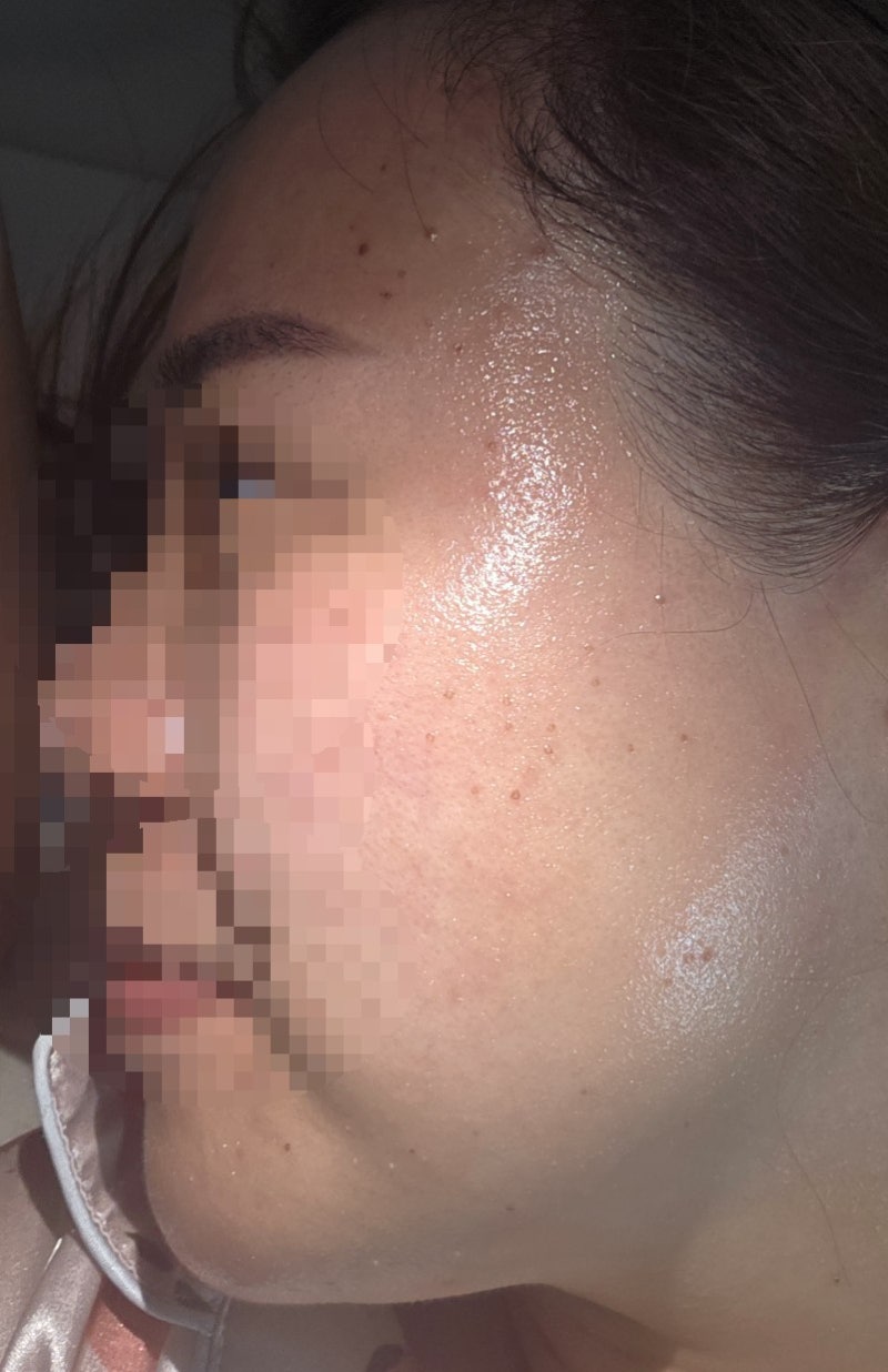 편평사마귀 거우침 제거후 3일 ,일주일후기!! 재생크림 추천