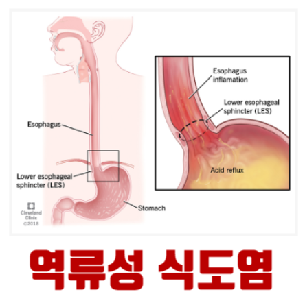 역류성 식도염 증상 원인 치료 예방, 후두염 협심증 심근경색 구별