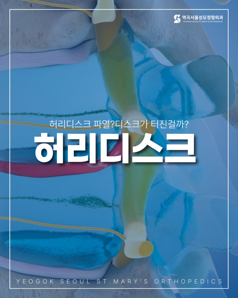 허리디스크 파열, 디스크 터졌다는 뜻일까요?