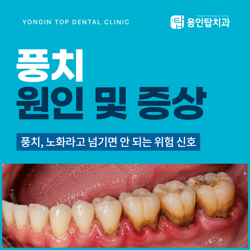 풍치증상, 노화라고 넘기면 안 되는 위험 신호