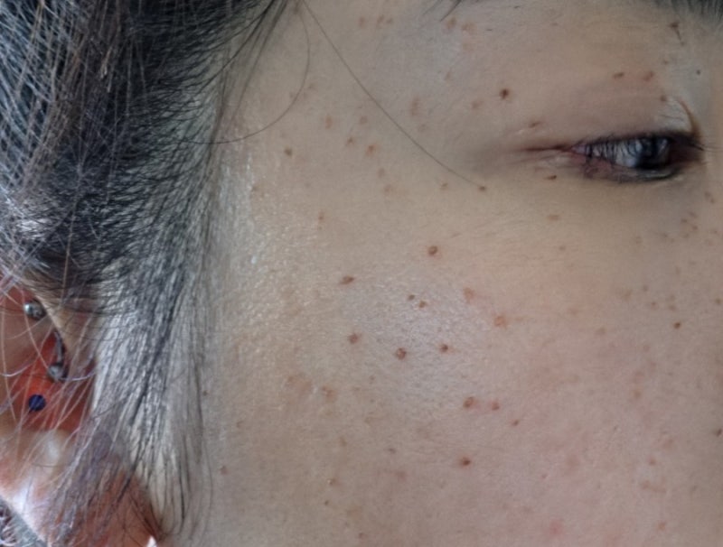 출산후 늘어난 편평사마귀 제거후 관리 후기(시술4일차~시술8일차)