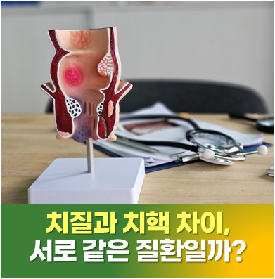 치질 치핵 차이, 같은 질환일까? 치핵·치열·치루 차이