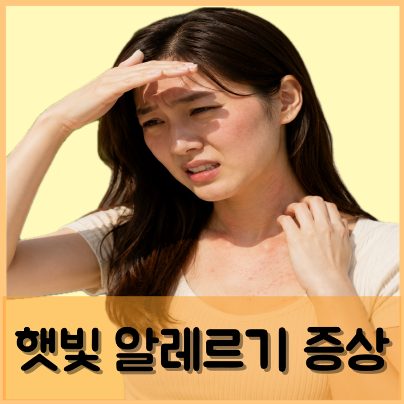햇빛 알레르기 증상 치료 연고 얼굴