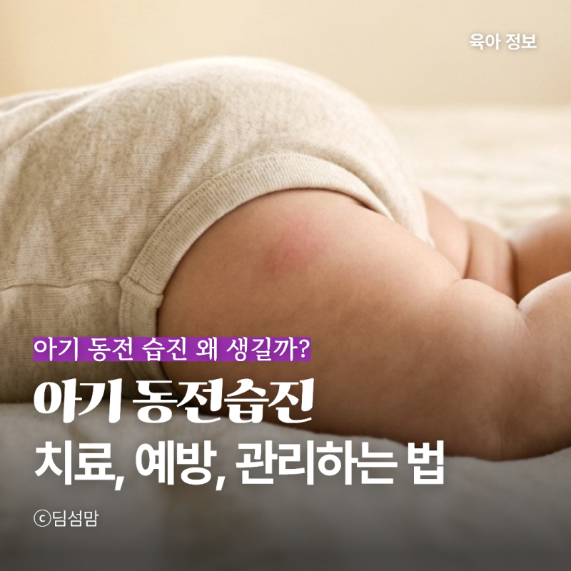 아기 동전습진 왜 생길까? 치료, 예방, 집에서 관리하는 법