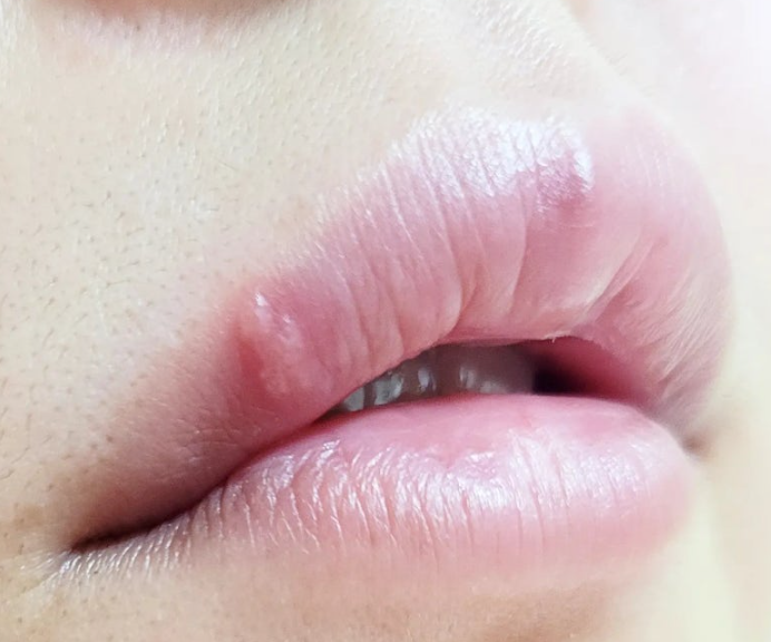 관계후 갑자기 생긴 입술 물집 이거 성병 인가요? 헤르페스 원인 증상
