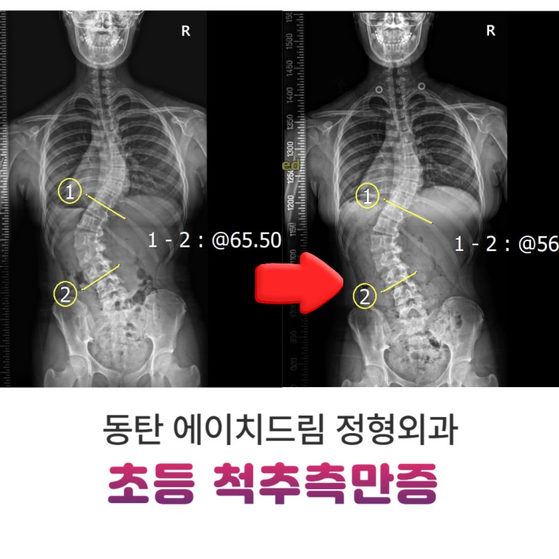 초등 척추측만증, 학교검진 후 가장 먼저 확인해야 하는 3가지