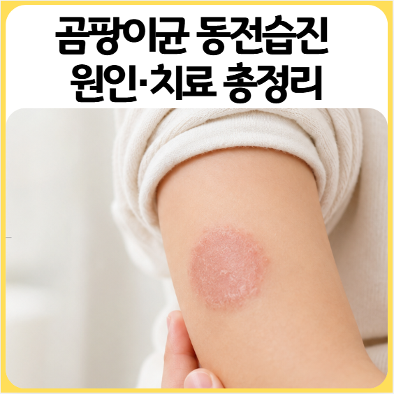 아기 곰팡이균 동전습진 원인 증상 연고 치료까지 총정리