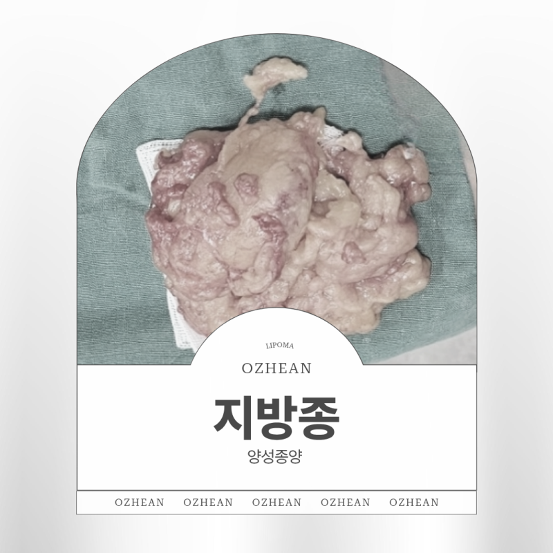 엉덩이 덩어리 불편한 지방종 계속 커진다면