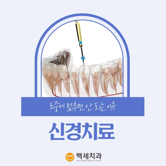 의정부치과추천 신경치료 도중에 멈추면 안 되는 이유