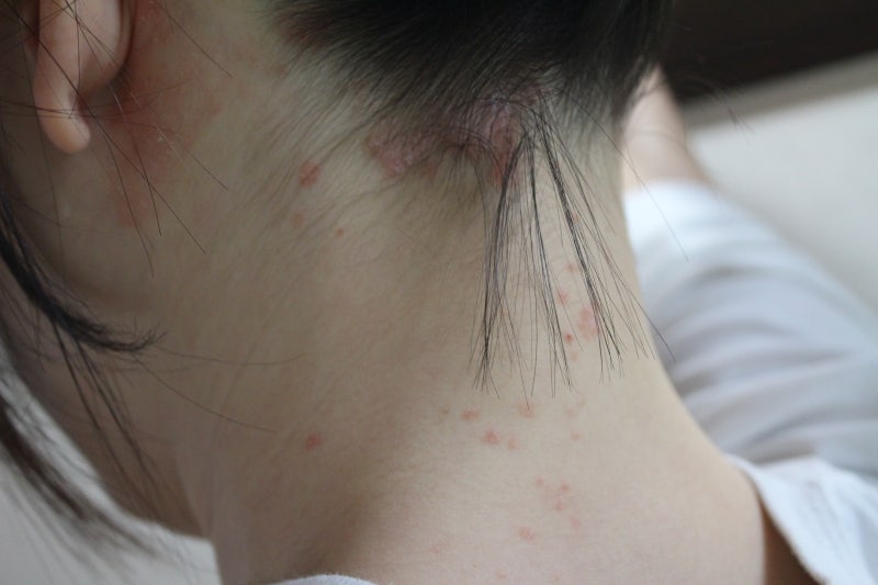20~30대에 시작되는 두피 건선, 이마·귀 뒤로 번졌다면? 최신 근거 기반 3F 통합 치료 전략