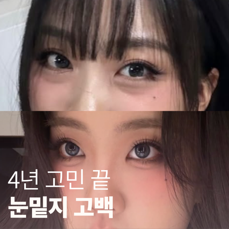 "4년 고민" 이영지 눈밑지 전후, 다이어트보다 더 놀랐다