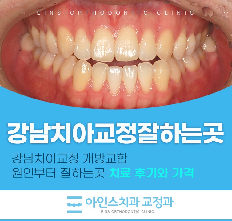강남치아교정 개방교합 원인부터 잘하는곳 치료 후기와 가격